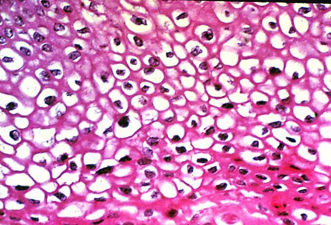 Koyu renkli boyanan hücre çekirdeği etrafında pembe renkli  eosin boyasını tutmayan boş alanlar, tümör oluşumuna sebep olan virüs enfeksiyonlarında görülen bir patolojik bulgudur