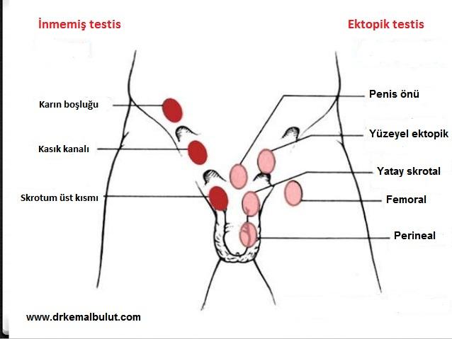 İnmemiş testis ve ektopik testiste testisin yerleşim noktaları