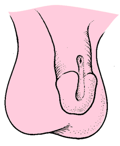 Epispadiasta üretra hipospadiasın tersine altta değil penisin üstünde açılmaktadır.