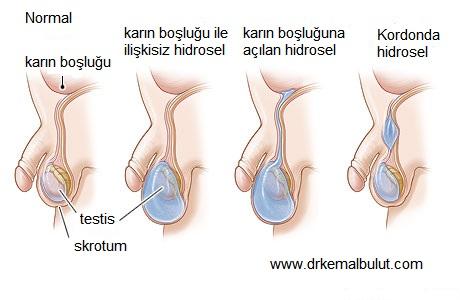 Hidrosel sık görülen doğumsal bir anomali olabileceği gibi travma gibi nedenlerle sonradan da gelişebilir