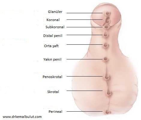 Hipospadias nedeni ile sperm hücrelerinin rahim ağzında toplanamaması infertilite nedeni olabilir.