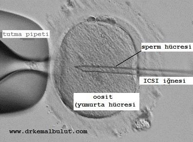 ICSI işleminde sperm doğrdan dişi yumurtası ( oosit ) içine  enjekte edilmektedir