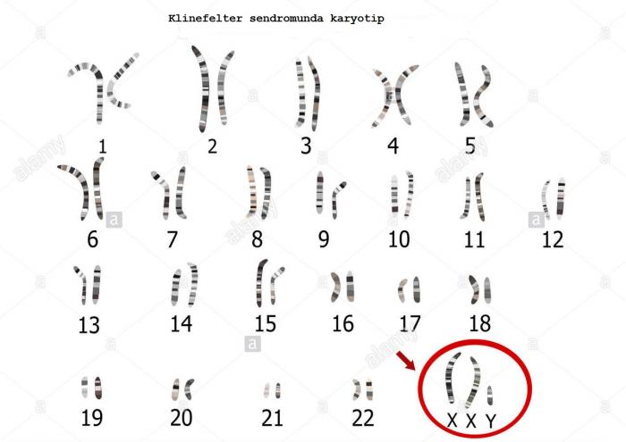 Klinefelter sendromunda 47, XXY kromozom şeklinde karyotip analizi. Fazladan X kromozomu nedeniyle 46 tane olması gereken kromozom sayısı 47 tanedir.