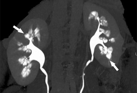 Tomografi de medüller sünger böbrek görünümü