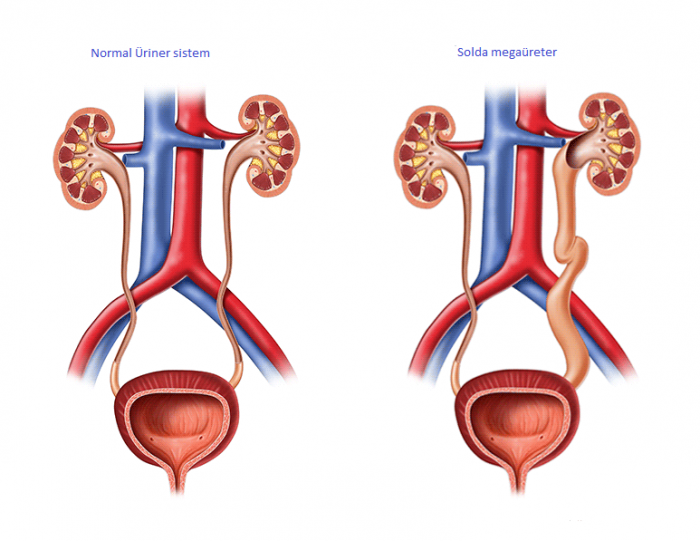 Normal üriner sistem ve yanda solda megaüreterli üriner sistem 