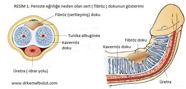 Peyronie Hastalığı