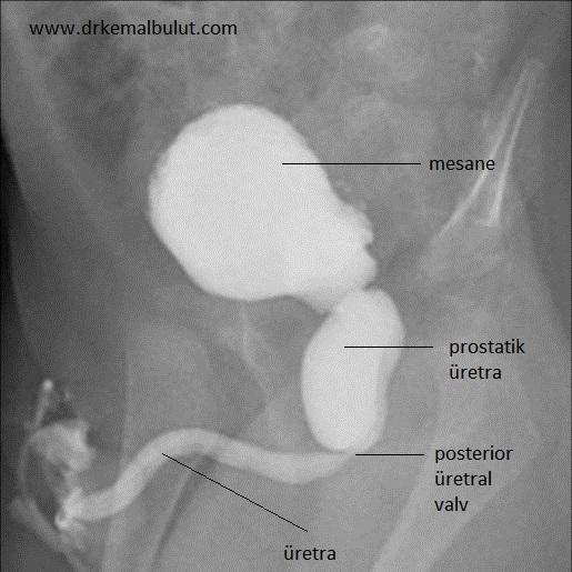 işeme sistografisinde posterior üretral valv ( PUV)