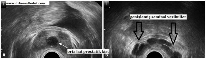 Solda intraprostatik orta hat kisti ve sağda aynı hastada seminal veziküllerde genişleme