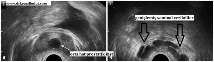 İnfertil azospermik hastada TRUS de prostat içinde orta kisti ve seminal veziküllerde genişleme.