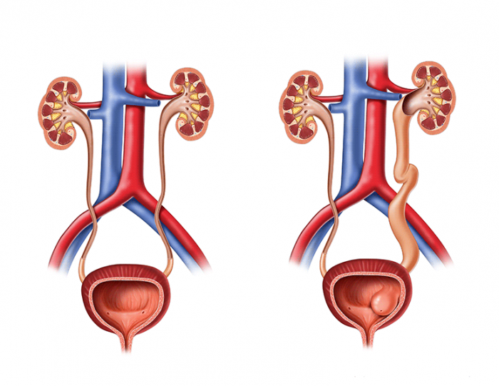 Normal üriner sistem ve yanda solda üreterosel olan üriner sistem görünümü