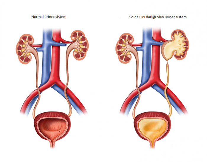 Normal üriner sistem ve yanda solda üreteropelvik bileşke ( UPJ) darlığı olan üriner  sistem görünümü