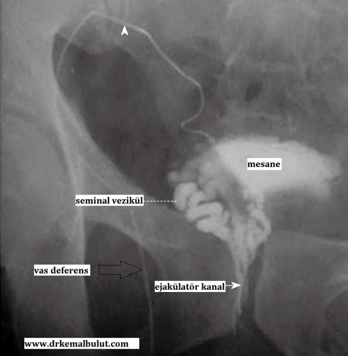 vazavezikülografide görülen obstrüksiyonu ( tıkanma) olmayan normal bir erkekte radyolojik çaşılma