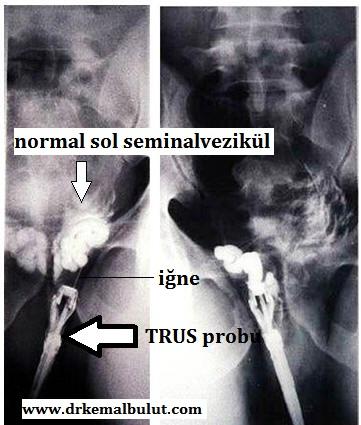 TRUS eşliğinde seminalvezikülografi ve aspirasyon, normal görünüm 