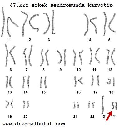 47, XYY erkek sendromunda karyotip analizi