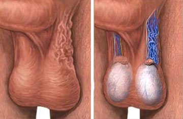 Sol testiste varikoselin şematik görünümü, solda spermatik kordondaki ciltten bile belli olabilen büyük genişlemiş damarlar