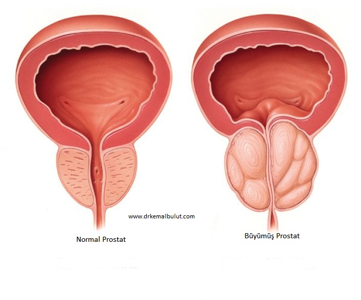 Prostatın İyi Huylu Büyümesinde (BPH) idrar çıkımını daraltması