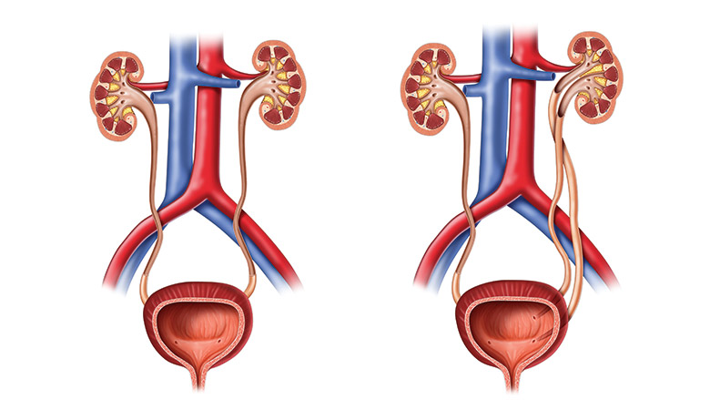 Normal üriner sistem ve yanda solda tam üreter duplikasyonu olan üriner sistem görünümü