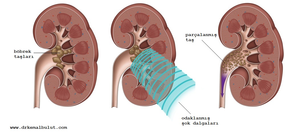 odaklanmış ses dalgaları ile taş parçalara ayrılır ve idrar ile ağrısız bir şekilde dışarı atılır
