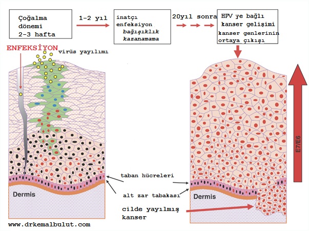 HPV virüsü cilt yoluyla bulaştığında cildin en yüzeyel tabakası olan epidermiste en tabanda bulunan hücreler içinde çoğalır, yüzeye doğru göç ederek, en üst hücrelerde dökülmeye sebep olurken bu hücrelerin içinde kendini de yaymış olur, bağışıklık gelişmez ise uzun süreler sonunda kanser oluşumuna neden olabilir.