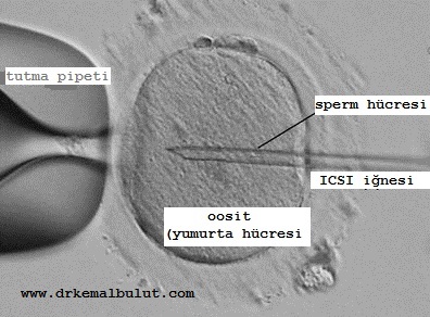 ICSI işleminde sperm doğrudan dişi yumurtası içine enjekte edilmektedir.