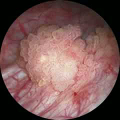 Endoskopide mesane kanserinin görünümü