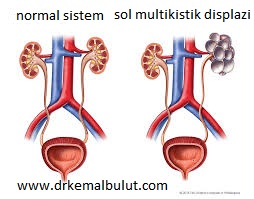 sol multikistik displazik böbrek
