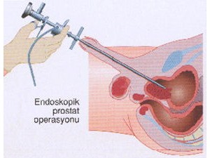 İyi huylu prostat büyümesinde (BPH) en sık yapılan endoskopik operasyonlar
