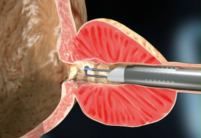 İyi huylu prostat büyümesinde (BPH) en yeni yöntemlerden biri olan plazmakinetik operasyon