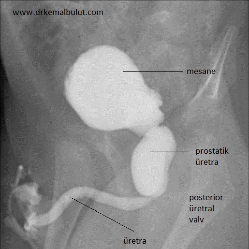 işeme sistografisinde posterior üretral valv