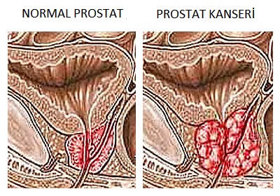 Prostat Kanseri son döneme kadara bulgu vermeyebilir