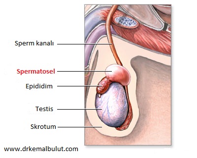 Spermatosel sık görülen bin doğumsal anomalidir.