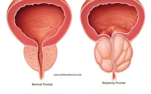 Prostatın İyi Huylu Büyümesinde (BPH) idrar çıkımını daraltması