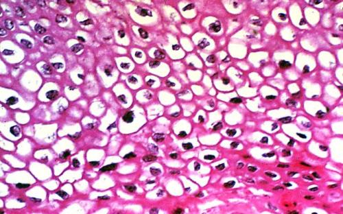 HPV virüsünün etkilediği bölgeden alınan cildin patolojik görünümü HPV için çok spesifik değildir, koilostoz denen içi boşalmış hücre görünümüne neden olur. Resimde boya almamış beyaz bölümler bunun bulgusudur. 