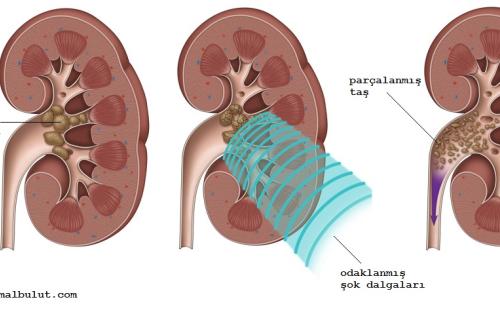 odaklanmış ses dalgaları ile taş parçalara ayrılır ve idrar ile ağrısız bir şekilde dışarı atılır
