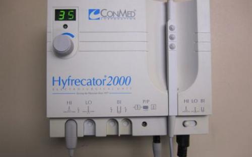 Genital kondilomların hızla yok edilmesinde, yüksek frekanslı düşük güç elektrokoterizasyon cihazı
