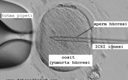 ICSI işleminde sperm doğrudan dişi yumurtası içine enjekte edilmektedir.