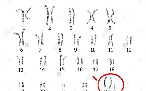 Klinefelter sendromunda 47, XXY kromozom şeklinde karyotip analizi. Fazladan X kromozomu nedeniyle 46 tane olması gereken kromozom sayısı 47 tanedir.