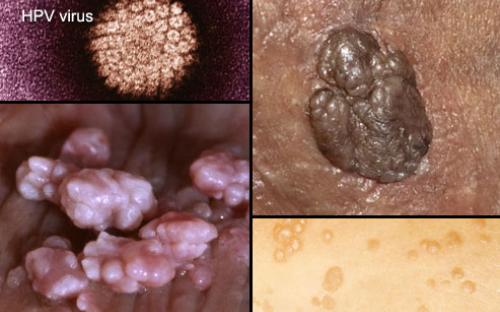 genital siğiller çok değişik şekilde görülebilir