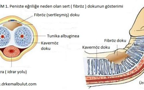 Peyronie Hastalığında sertleşmiş ( fibröz ) dokunun gösterimi