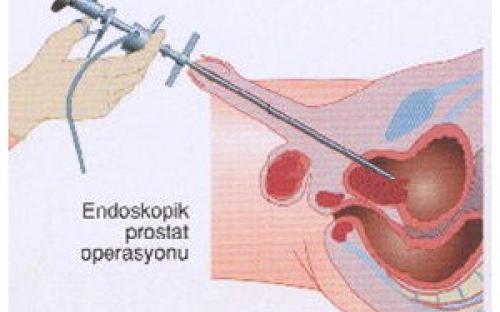 İyi huylu prostat büyümesinde (BPH) en sık yapılan endoskopik operasyonlar
