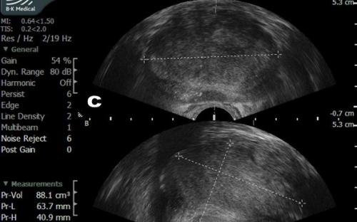 transrektal ultrasonografi eşliğinde prostat biyopsisi tanıda çok faydalıdır
