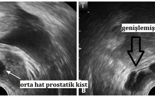 Transrektal ultrasonografide (solda)  intraprostatik orta hat kisti ve (sağda) aynı hastada seminal veziküllerde genişleme
