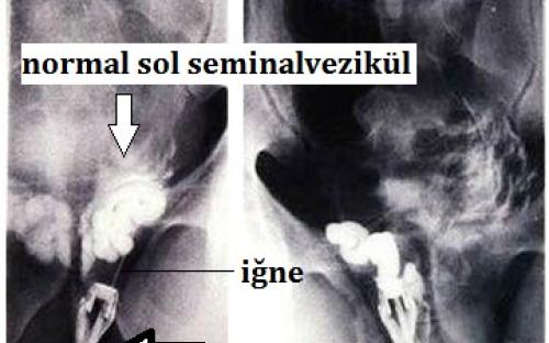TRUS eşliğinde seminal aspirasyon ve vezikülografi