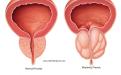 Prostatın İyi Huylu Büyümesinde (BPH) idrar çıkımını daraltması