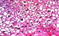 HPV virüsünün etkilediği bölgeden alınan cildin patolojik görünümü HPV için çok spesifik değildir, koilostoz denen içi boşalmış hücre görünümüne neden olur. Resimde boya almamış beyaz bölümler bunun bulgusudur. 