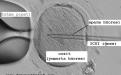 ICSI işleminde sperm doğrudan dişi yumurtası içine enjekte edilmektedir.