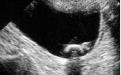 Ultrasonografide mesane taşının görünümü