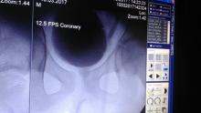 işeme sistografisi : 13 yaşında hasta solda üretere idrar reflüsü izleniyor