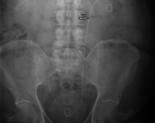 ESWL öncesi solda stent