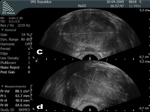 transrektal ultrasonografi eşliğinde prostat biyopsisi tanıda çok faydalıdır